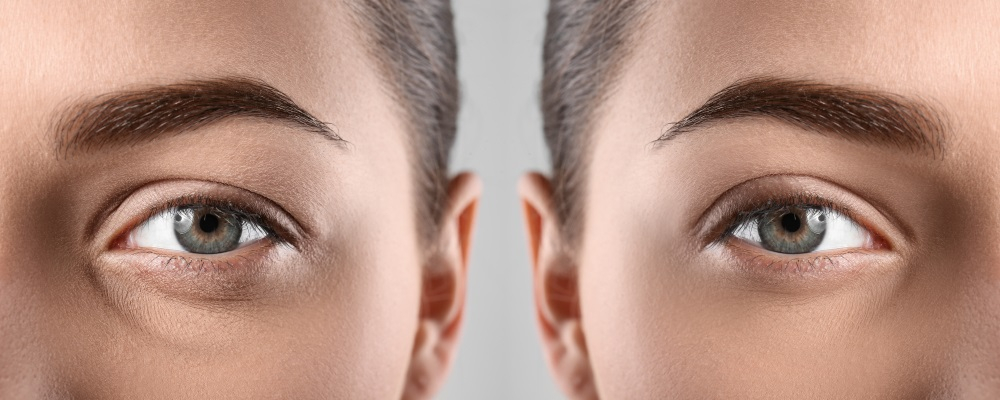Under-Eye Fat Removal Through Multiple Procedures